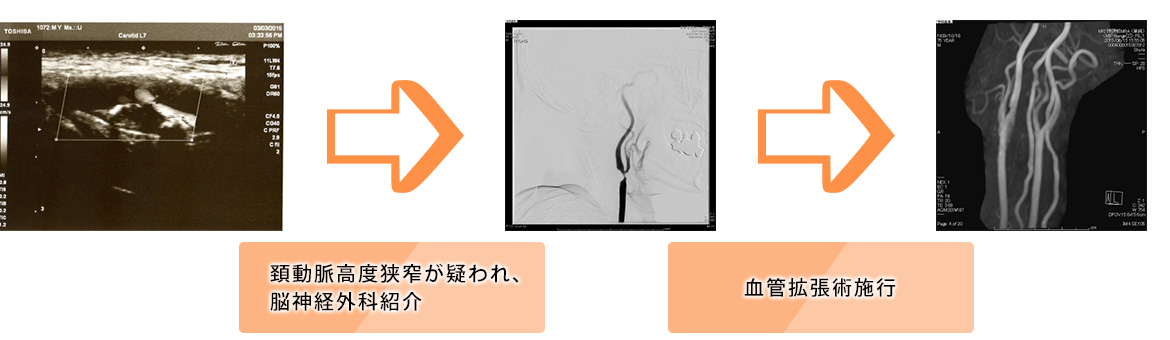 頚動脈エコー