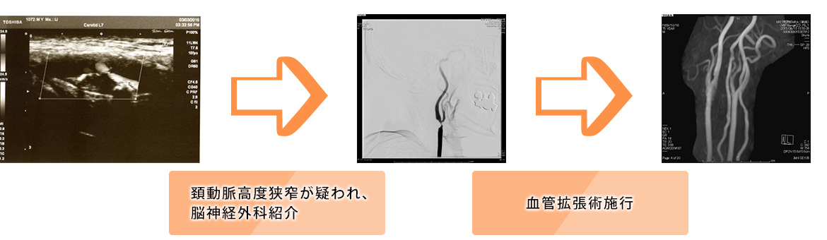 頚動脈エコー